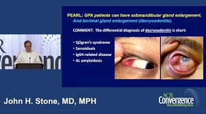 Image result for Dacryoadenitis