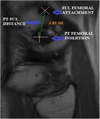 Overview the lateral collateral ligament, or lcl, is one of the four major ligaments that supports the knee joint. Measurement Of Distance Between Femoral Insertion Of Fibular Collateral Ligament And Popliteus Tendon A Magnetic Resonance Imaging Based Study Journal Of Clinical Orthopaedics Trauma