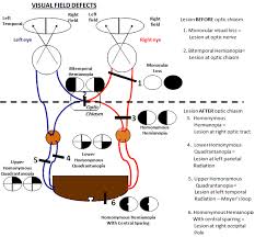 Image result for Visual Field Deficit