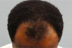 Black males tend to lose their hair for the same reasons as other races, including male pattern baldness. Causes Of Hair Loss For Black Men Protress Hair Care