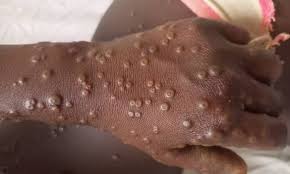 Mpox ในเซเนกัล: กระทรวงสาธารณสุขยกระดับการเฝ้าระวัง - Imagen principal del artículo