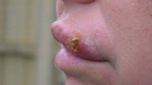 Image result for Angular Stomatitis