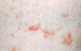 Image result for scabies symptoms
