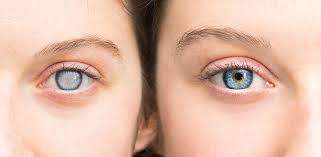 A cataract is a clouding of the normally clear lens of your eye. Cataracts Dearborn Cataract Surgery Livonia Osm