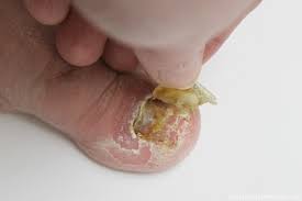 It is worth noting that in case after using the methods on how to get rid of toenail. One Ingredient Toenail Fungus Cure