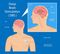 This leads to a reduction in a chemical called dopamine in the brain. Parkinson S Disease Symptoms And Early Warning Signs Of Pd