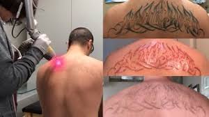 Tattoo removal creams work by bleaching or peeling away the top layer of the skin. Laser Tattoo Removal The Ugly Truth Youtube