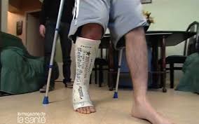 Ca tire un peu, comme si la peau n'était plus assez élastique. Double Fracture Tibia Perone La Jambe Brisee