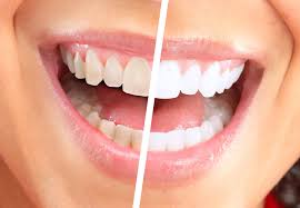 We did not find results for: Teeth Whitening Cost And Information The Dental Guide Uk