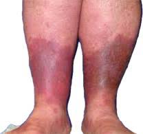 Image result for Lipodermatosclerosis