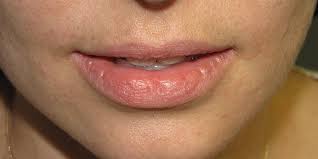 Image result for Lip Cancer