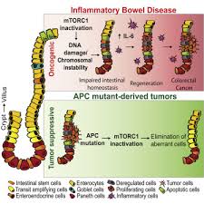 A biopsy is the only one way to ensure a diagnosis of inflammatory bowel syndrome and make sure that these symptoms are not a sign of cancer. Mtorc1 Inactivation Promotes Colitis Induced Colorectal Cancer But Protects From Apc Loss Dependent Tumorigenesis Sciencedirect