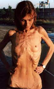 Anorexic girls nude | Picsegg.com
