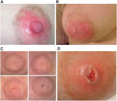 Postpartum Nipple Symptoms: Risk Factors and Dermatologic Characterization  | Breastfeeding Medicine
