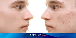 Baking soda, sodium bikarbonat, natrium hidrogen karbonat) adalah senyawa kimia dengan rumus nahco3. Kegunaan Baking Soda Untuk Jerawat Apakah Aman Dan Efektif Halaman All Kompas Com