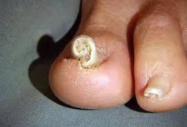 Image result for Clubbing nails feet