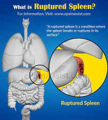 A ruptured spleen usually caused. Ruptured Spleen Causes Signs Symptoms Tests Treatment Prevention