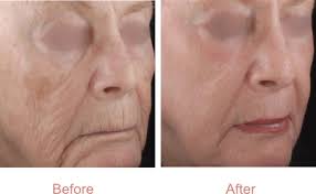 Skin Laser Resurfacing in Bolton, Manchester
