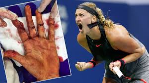 Petra kvitova zieht nach kurioser verletzung zurück. Petra Kvitova Instagram Shefalitayal