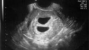 You can catch an earlier coach if you are quick through passport control, but there is a £5 ticket amendment fee for doing so. Transvaginal Ultrasound During Pregnancy