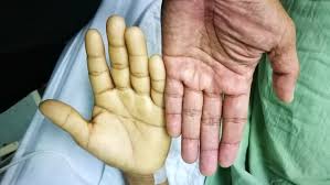 Multe probleme pot duce la exces de fier. Ce Este Anemia Cum Poate Fi Depistata Si Cum Se Trateaza Medlife