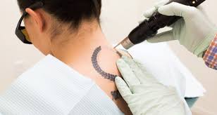 Removing tattoos at home could leave you with serious problems on your hands: How Does Fresh Tattoo Removal Work In 2021 Home Remedies
