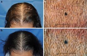 Other options include light therapy, hormone therapy, or in some cases, hair transplants. Male And Female Pattern Hair Loss Before And After Lasercomb Treatment Download Scientific Diagram