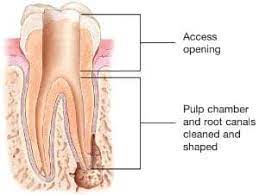 Check spelling or type a new query. Root Canal In Spanish