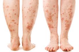 Psoríase é uma doença de pele não contagiosa, crônica, de origem pouco conhecida e que causa muita incomodação. Psoriase 10 Coisas Que Voce Precisa Saber Sobre A Doenca Mulher Com Saude