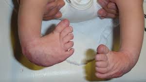Der sichelfuß ist eine häufige, meist flexible fußdeformität, die sich in nahezu allen fällen im verlauf des wachstums spontan korrigiert. Erkrankungen Im Kindes Und Jugendalter