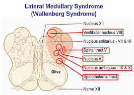 Step 1 Neuro Flashcards Quizlet Syndrome Neurology Spinothalamic Tract