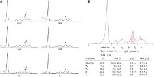 Increasing evidence for a multistep transformation process. Challenges Of Measuring Monoclonal Proteins In Serum