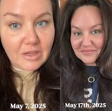 I got messages yesterday saying they could already notice a difference in  the inflammation of my face. Having a round face has always been something  I've been so self conscious about. Yes,