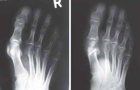 Dabei werden immer die sperrenden weichteile auf der außenseite des gelenkes mitabgelöst. Hallux Valgus Indikation Und Therapie