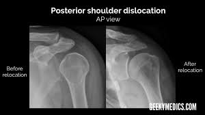 Image result for Shoulder XRay