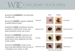 There are multiple types of nonmelanoma skin cancer, but the main forms are basal cell carcinoma, squamous cell carcinoma and merkel cell. Skin Cancer Screenings Treatments