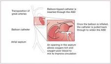 Image result for rashkind balloon atrial septostomy