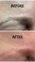 Laser Tattoo Removal | 💥Eyebrow Removal💥 . Do you have unwanted ...