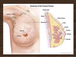 Like dcis, the cancer cells haven't yet invaded. Breast Cancer