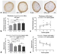Bladder-like self-organization of BCa organoids. Distribution of BCa...