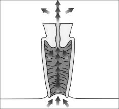 Sharp abdominal pain after hysterectomy other dangers are specific to hysterectomies, consisting of bowel conditions due to damage in the pelvic area or premature ovarian failure. Entrance Path For Gas Through Small Lacerations At Vaginal Stump After Download Scientific Diagram