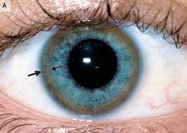 Was Ist Das Eigentlich Wenn Die Iris Des Auges Sich Abfarb Augen