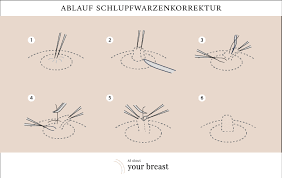 Schlupfwarzen Ursachen Was Sie Dagegen Tun Konnen Allaboutyourbreast
