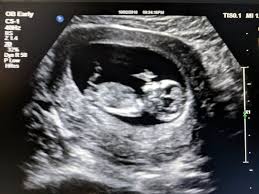 Subchorionic Hemorrhage At 12 Weeks Im Scared For My Boy