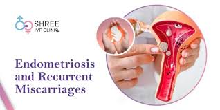 Image result for Recurrent Miscarriage