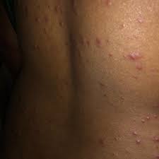 Image result for Rubella