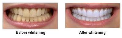 Teeth Whitening Bleaching Oralhealth In