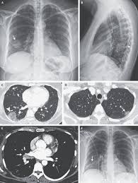 If the condition is misdiagnosed or its symptoms are ignored, a patient may not receive appropriate treatment until the cancer has progressed to an advanced stage. Case 25 2020 A 47 Year Old Woman With A Lung Mass Nejm