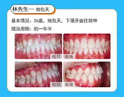 香港林先生箍牙案例 深圳維港歡樂牙科 矯正案例 地包天箍牙 cube tray