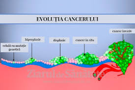 Se numeste uneori cancer osos secundar sau pe baza modului in care celulele arata la microscop, osteosarcoamele pot fi clasificate ca fiind de grad inalt, de grad intermediar sau de grad scazut. Cele 4 Stadii Ale Cancerului Ziarul De SÄnÄtate